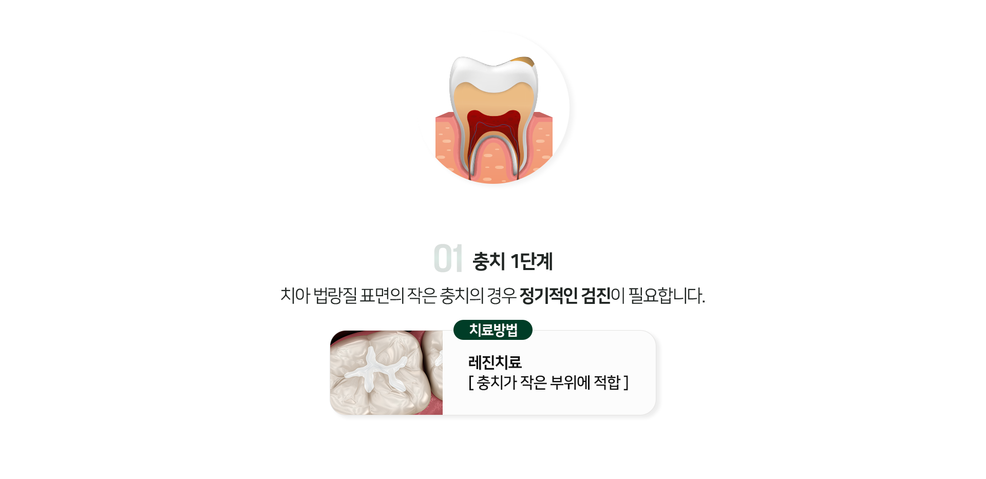 충치-1단계-치아-법랑질-표면의-작은-충치의-경우-정기적인-검진이-필요합니다-치료방법-레진치료-충치가-작은-부위에-적합